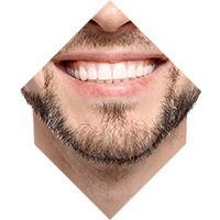 Protezare pe Implanturi dentare
