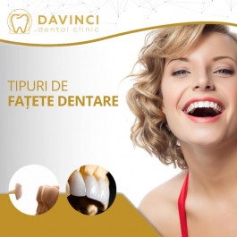 Tipuri de FAȚETE DENTARE
