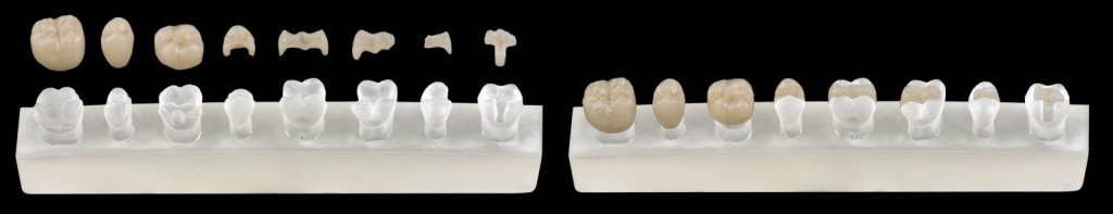 fatete, coroane, incrustatii, overlay davinci dental clinic