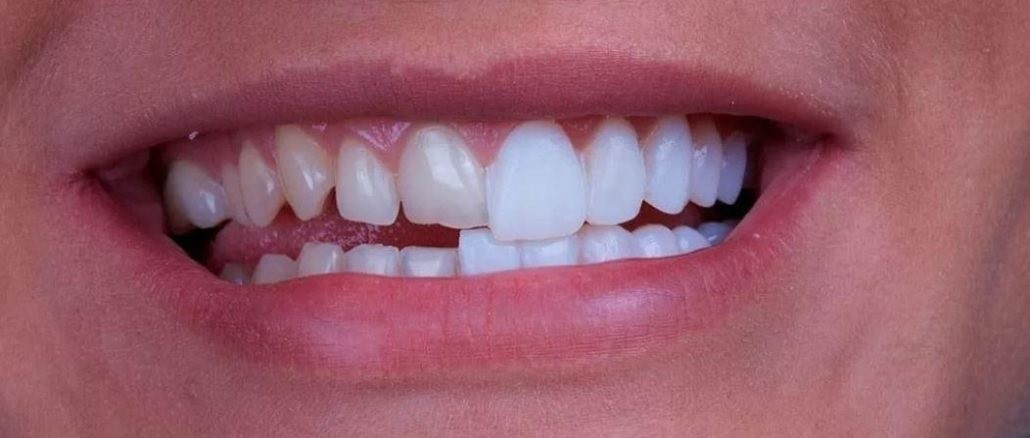 pacient inainte si dupa fatete dentare davinci dental clinic