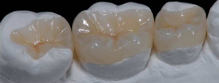 incrustatiile dentare mai bune decit obturatiile