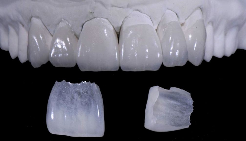 aplicare fatete pe dinte davinci dental clinic