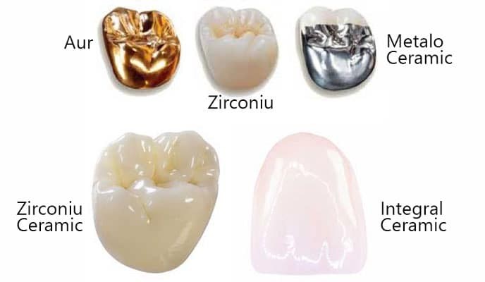 tipuri coroane dentare