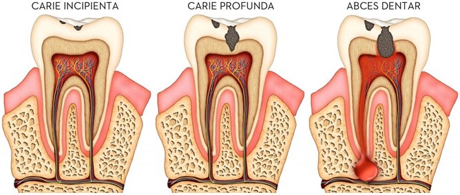 Carii dentare si tratarea lor cu mare eficienta in Chisinau